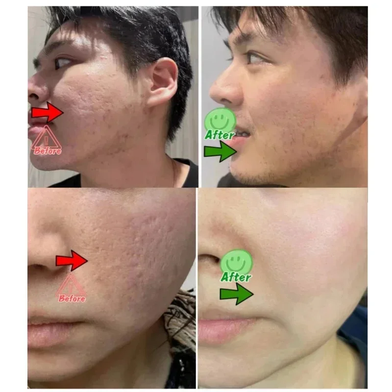 Крем для очищения пор с салици – обзор и цена Salicylic Acid Blackhead Remover