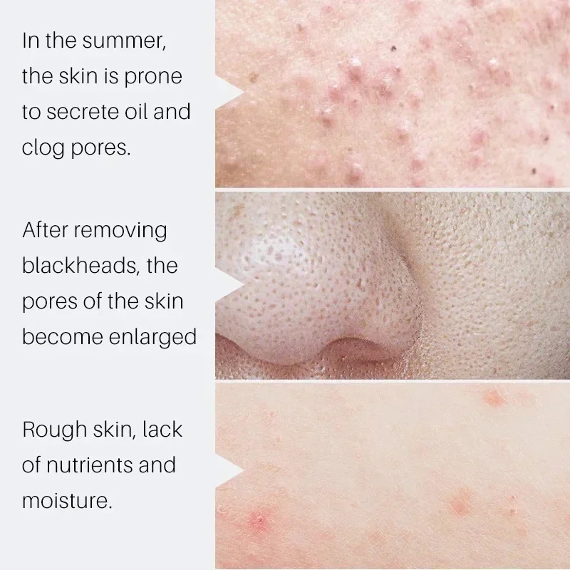 Сыворотка с салициловой кислот – обзор и цена Salicylic Acid Blackhead Remover