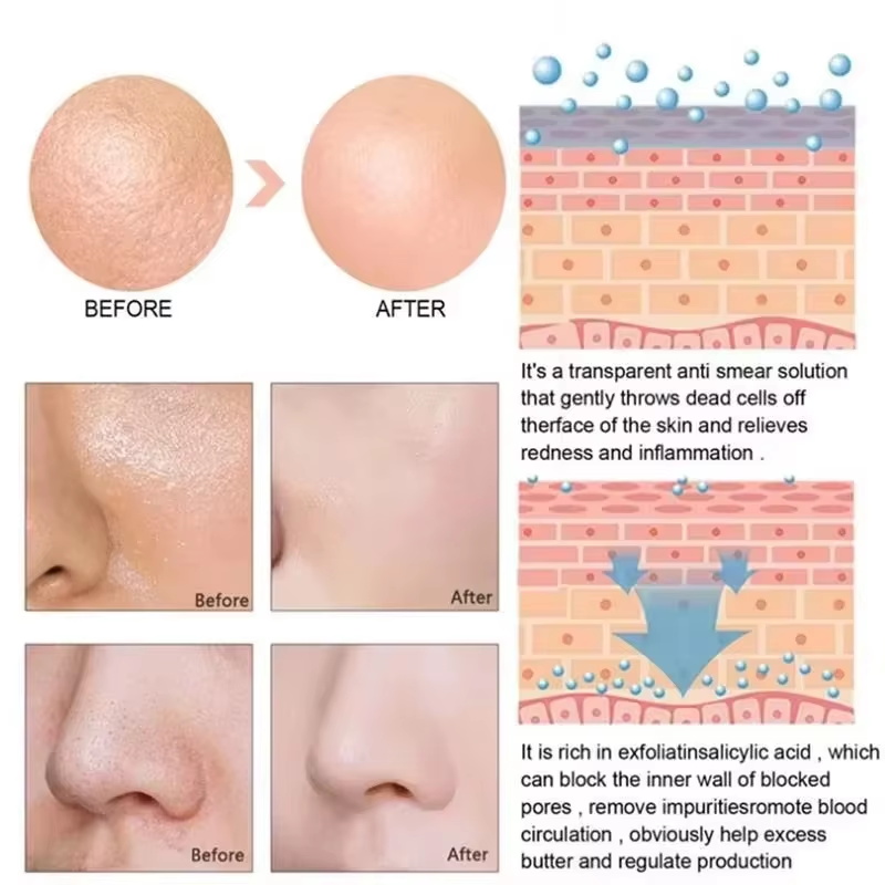 Сыворотка с салициловой кислот – обзор и цена Salicylic Acid Blackhead Remover