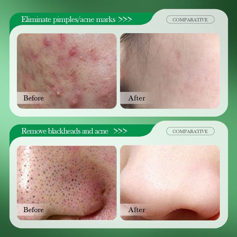 Крем для лечения акне с салици – обзор и цена Salicylic Acid Blackhead Remover